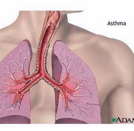 Бронхіальна астма